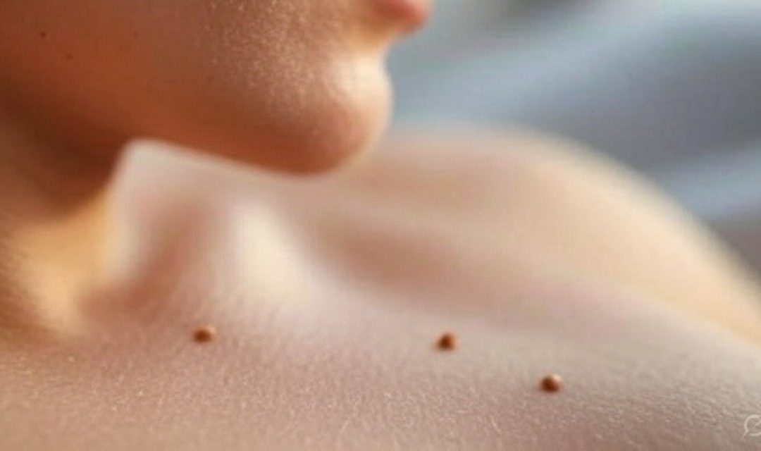 Veneto, nessun taglio alle visite dermatologiche: chiarimenti sulla mappatura dei nei