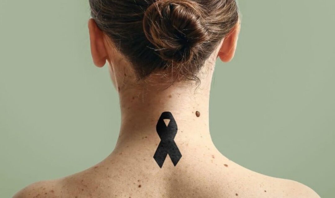Melanoma Day a Santa Giustina: il 18 giugno una serata pubblica sulla prevenzione e il 27 uno stand alla pedonata di Salzan